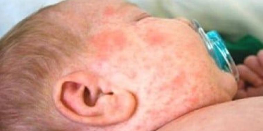 وزارة الصحة تطلق حملة تطعيم مجانية ضد الحصبة والحصبة الألمانية