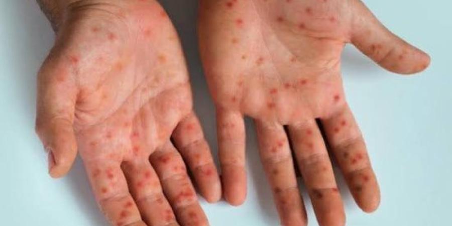 انطلاق الحملة القومية للتطعيم ضد الحصبة غدا.. واستهداف 1.9 مليون طفل بالجيزة :اليوم السابع